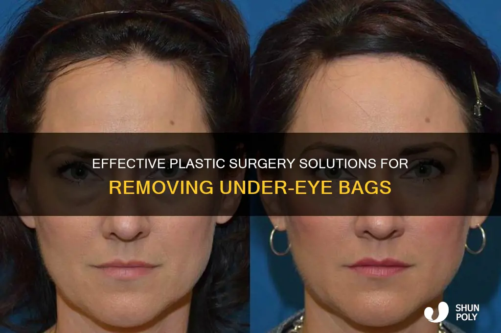 how to remove bags under eyes plastic surgery