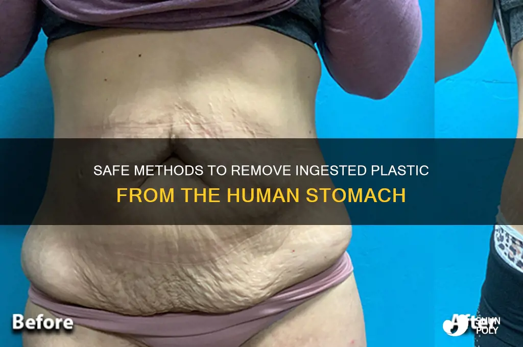 how to remove plastic from human stomach