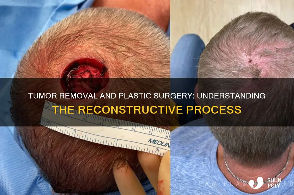 is a tumor removale plastic surgery