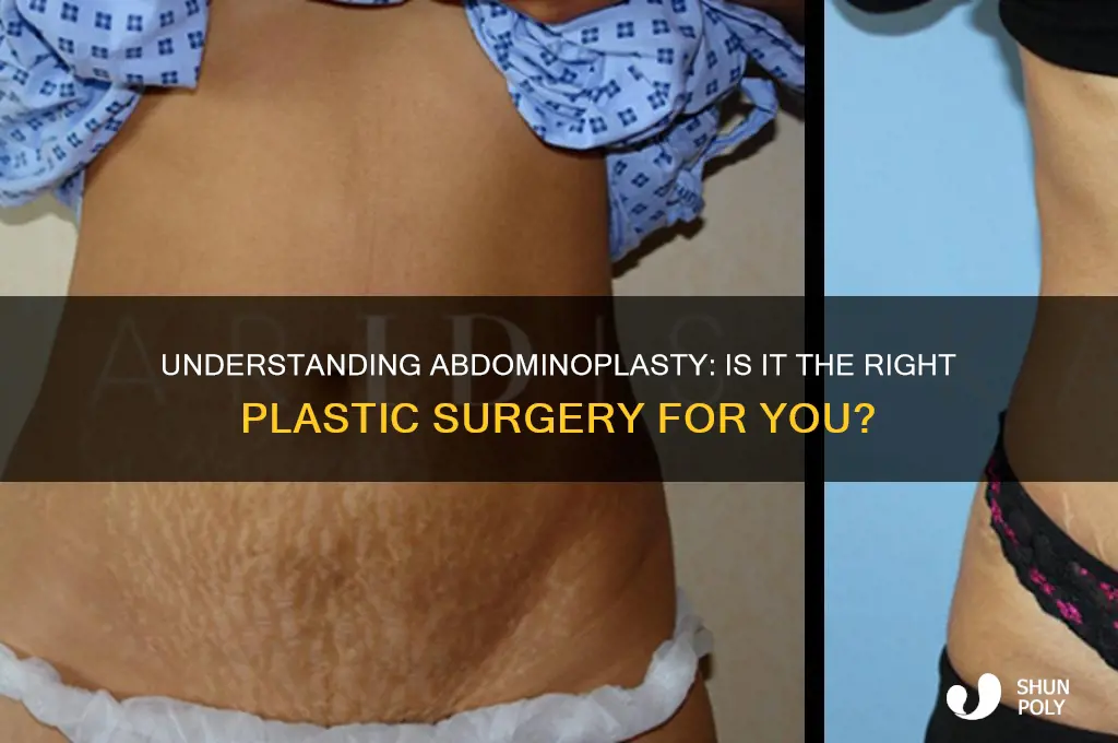 is abdominoplasty plastic surgery