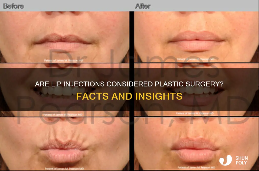 is lip injections plastic surgery