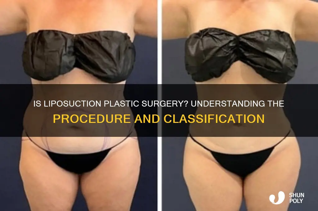is liposuction a form of plastic surgery