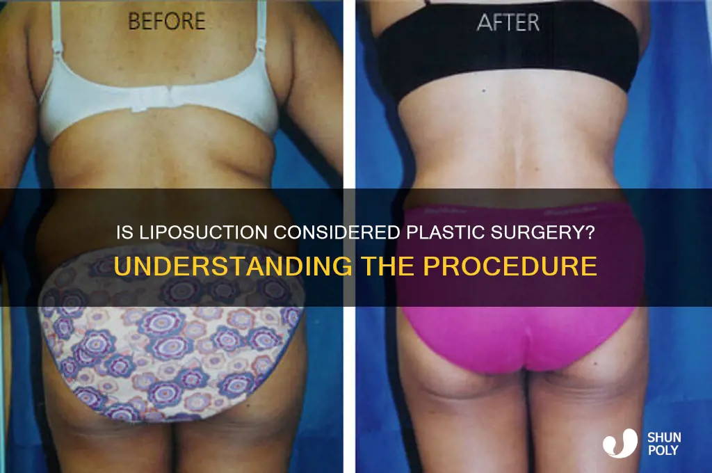 is liposuction plastic surgery