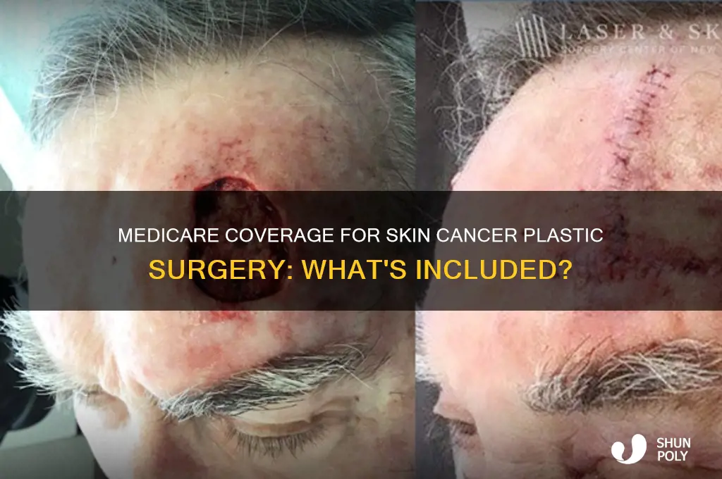 is plastic surgery for skin cancer covered by medicare