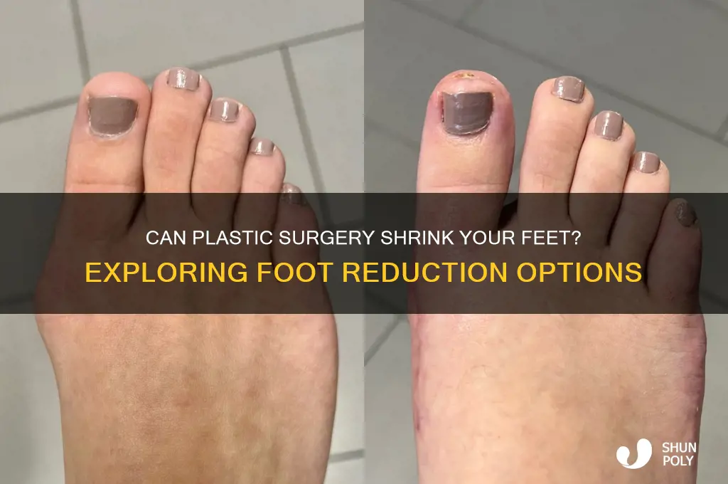 is there a plastic surgery to make your feet smaller
