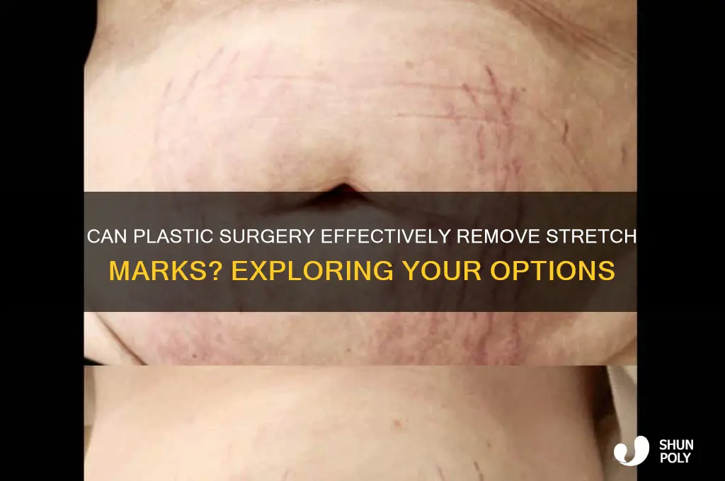 is there a plastic surgery to remove stretch marks