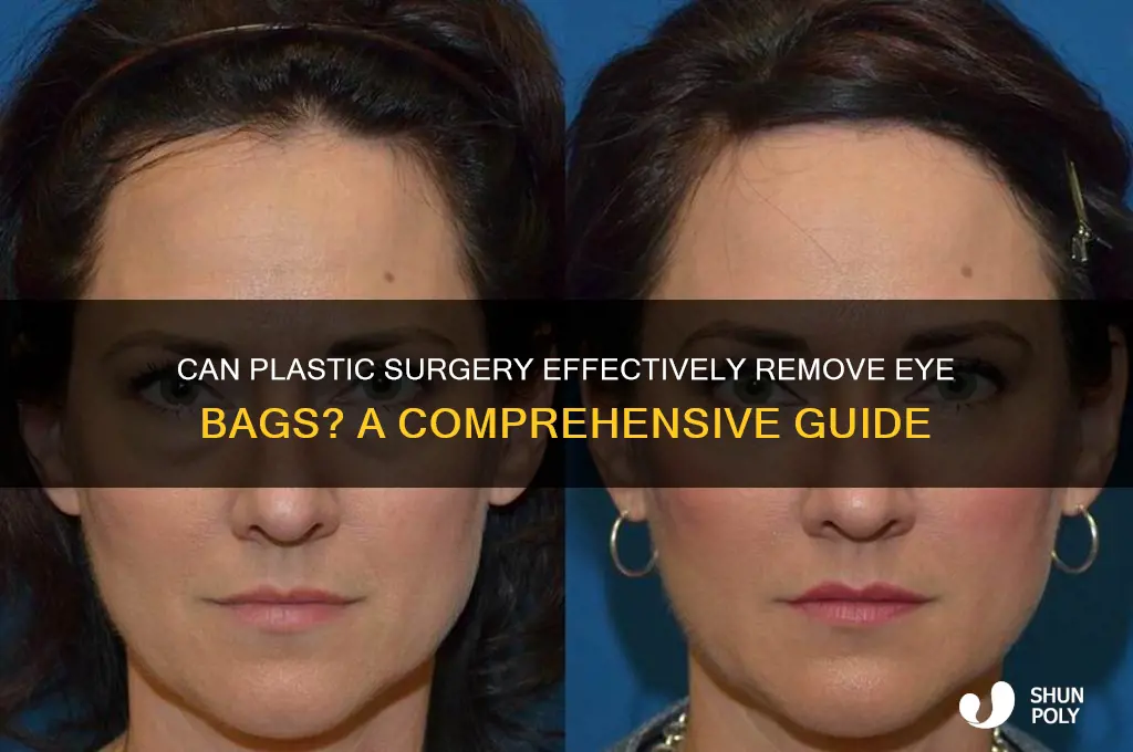 is there plastic surgery for eye bags