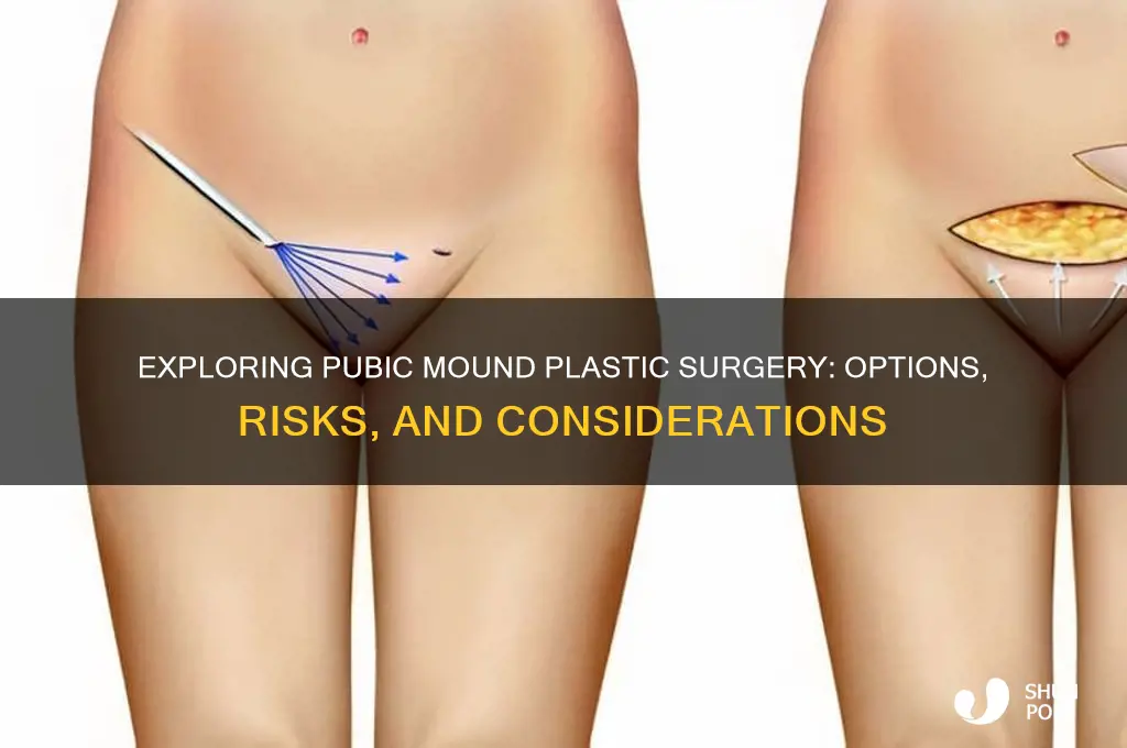 is there pubic mound plastic surgery