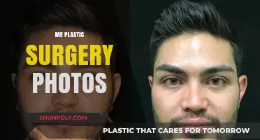 Transforming Beauty: My Plastic Surgery Journey in Photos