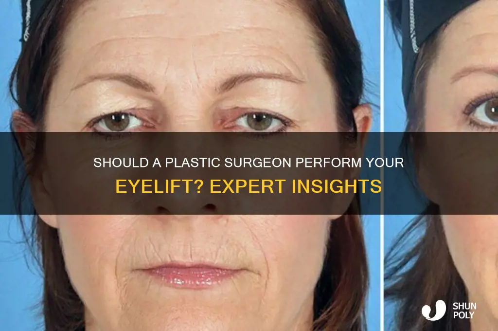 should a plastic surgeon do my eyelift