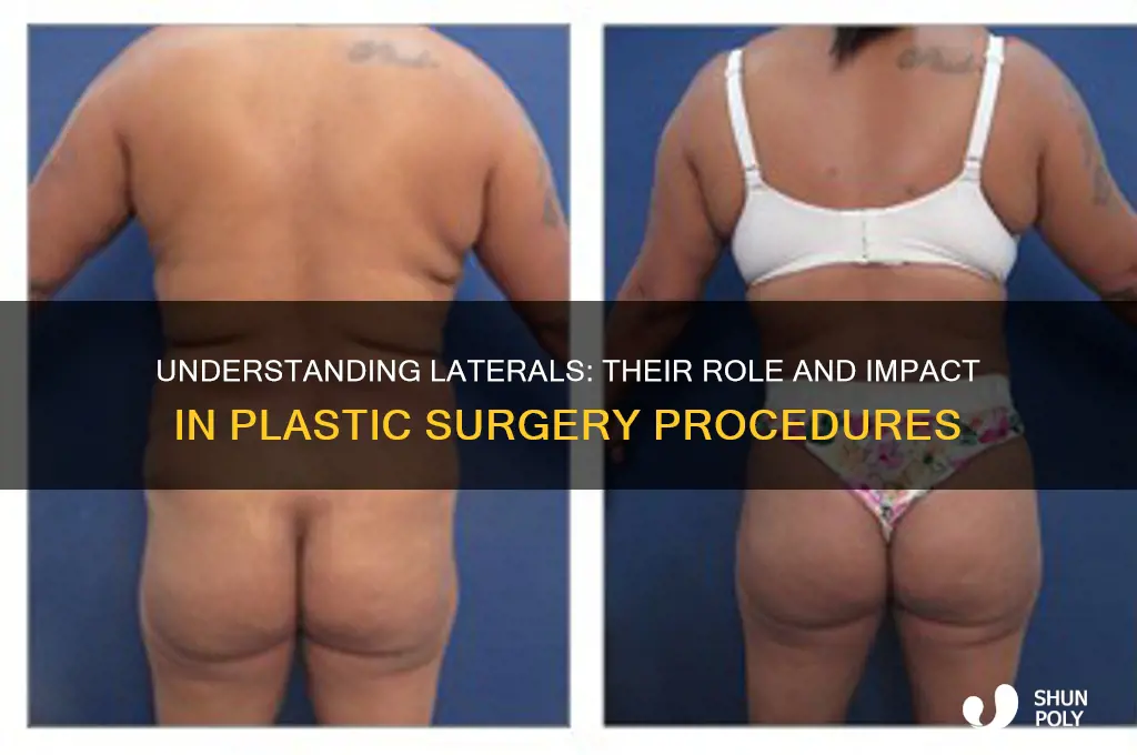 what are laterals in plastic surgery