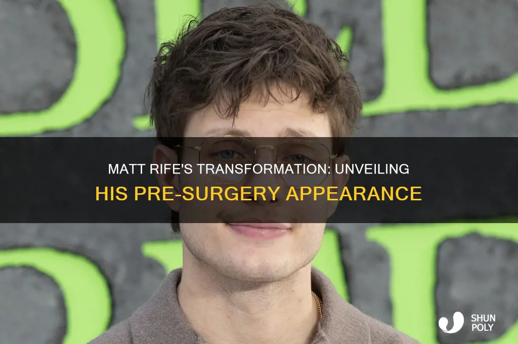 what did matt rife look like before plastic surgery