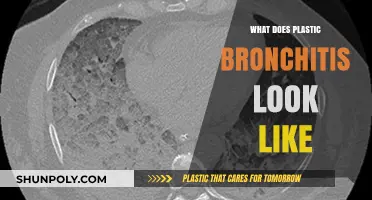 Plastic Bronchitis: Symptoms, Causes, and Treatments