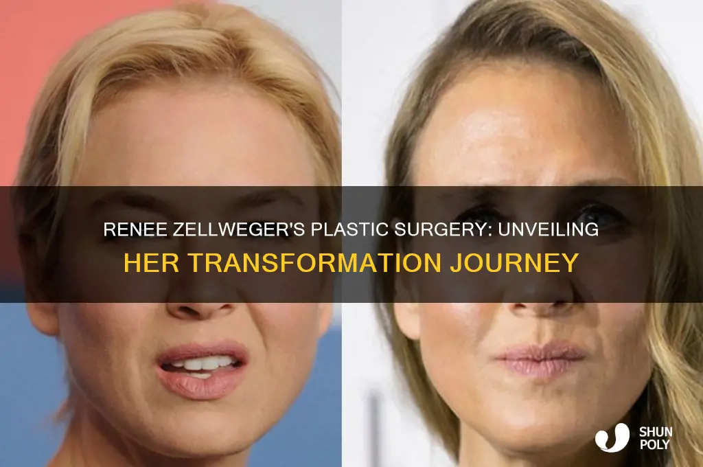 what exact plastic surgery has renee zellweger had