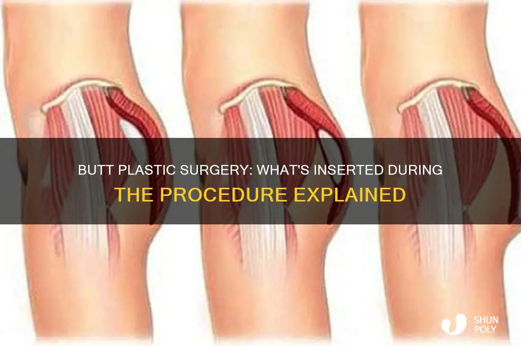 what goes in your butt during butt plastic surgery
