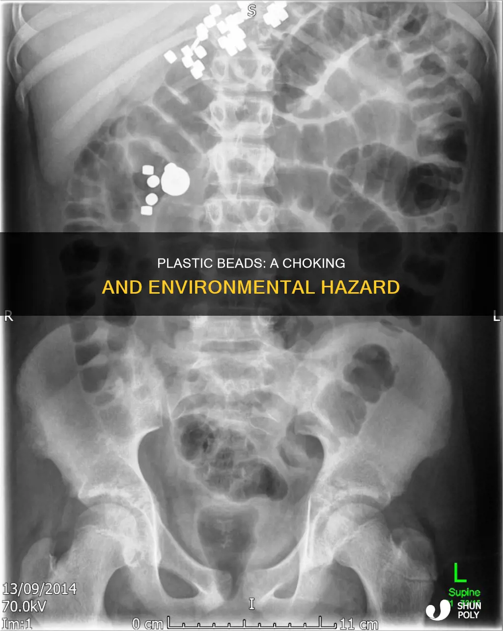 what happens if you swallow plastic beads