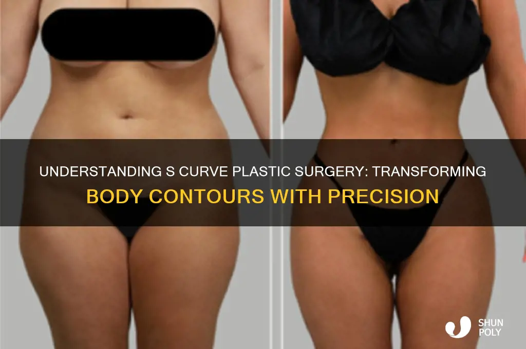 what is an s curve plastic surgery