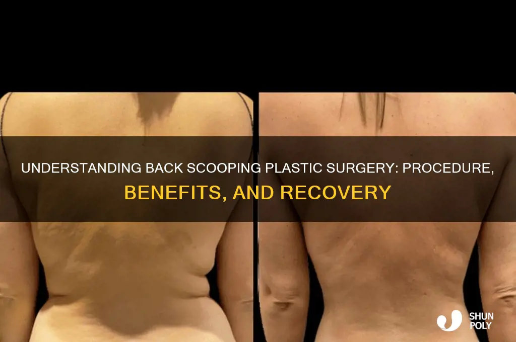 what is back scooping plastic surgery