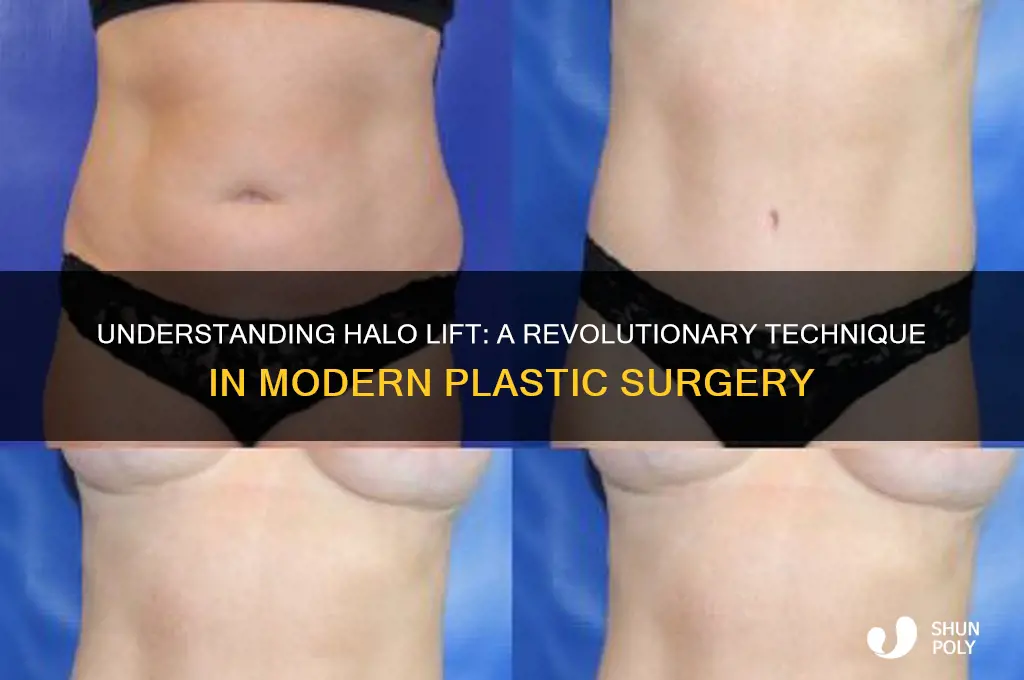 what is halo lift in plastic surgery