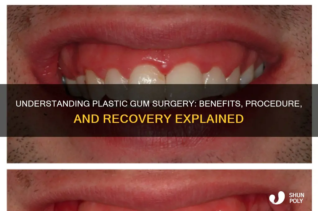 what is plastic gum surgery