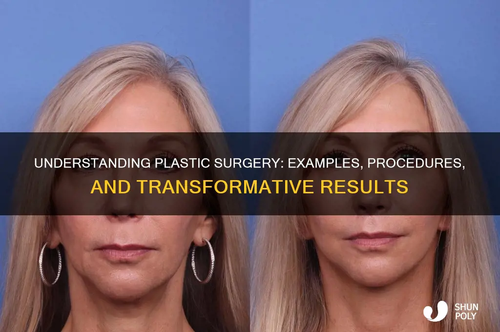 what is plastic surgery example
