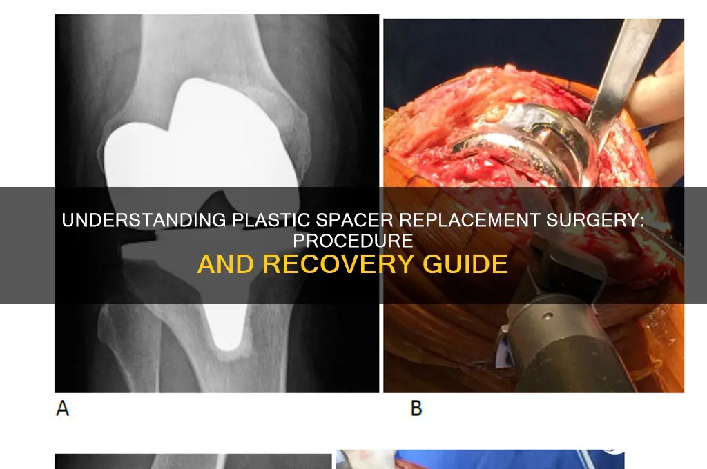 what is the procedure for plastic spacer replacement surgery