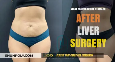 Post-Liver Surgery Complication: Understanding Plastic in the Stomach