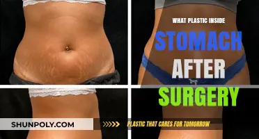 Post-Surgery Plastic in Stomach: Causes, Risks, and Prevention Tips
