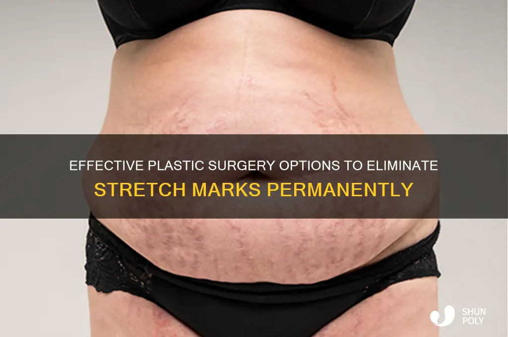 what plastic surgery can remove stretch marks