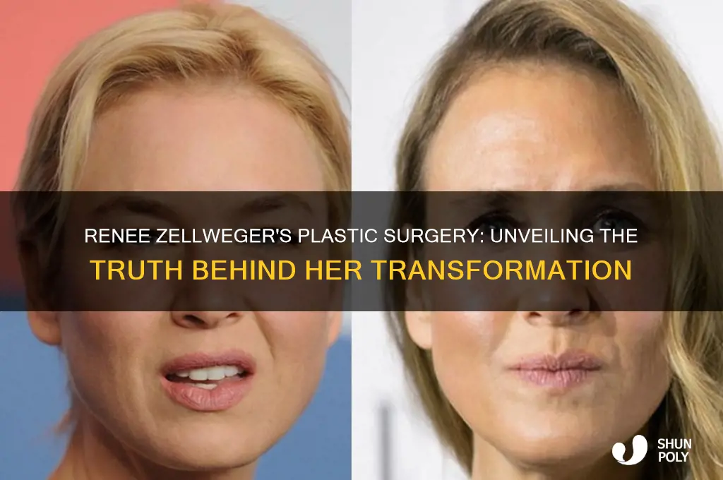 what plastic surgery did renee zellwager have