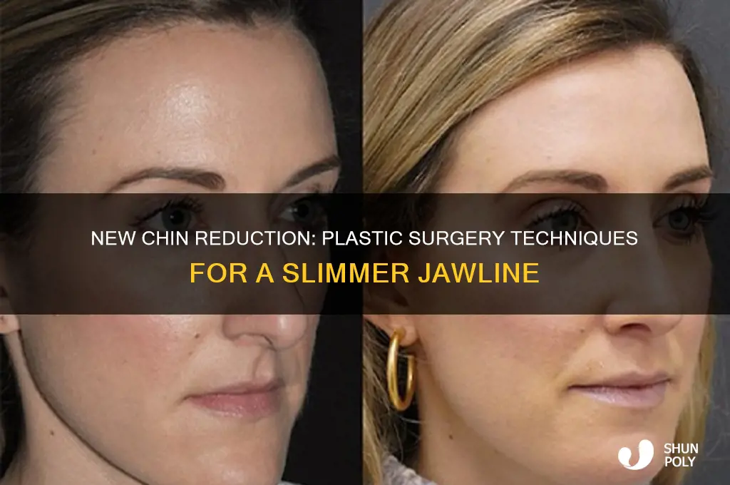 what plastic surgery does the new chin reduction