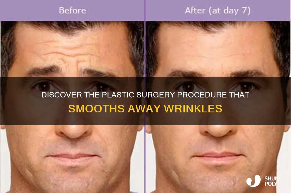 which type of plastic surgery erases wrinkles