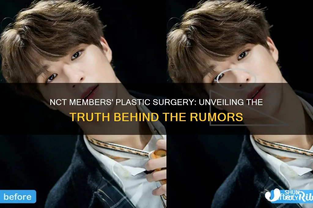 who had plastic surgery in nct