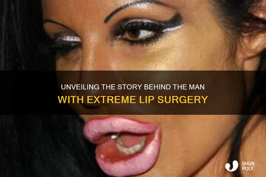 who is that crazy looking guy huge lips plastic surgery