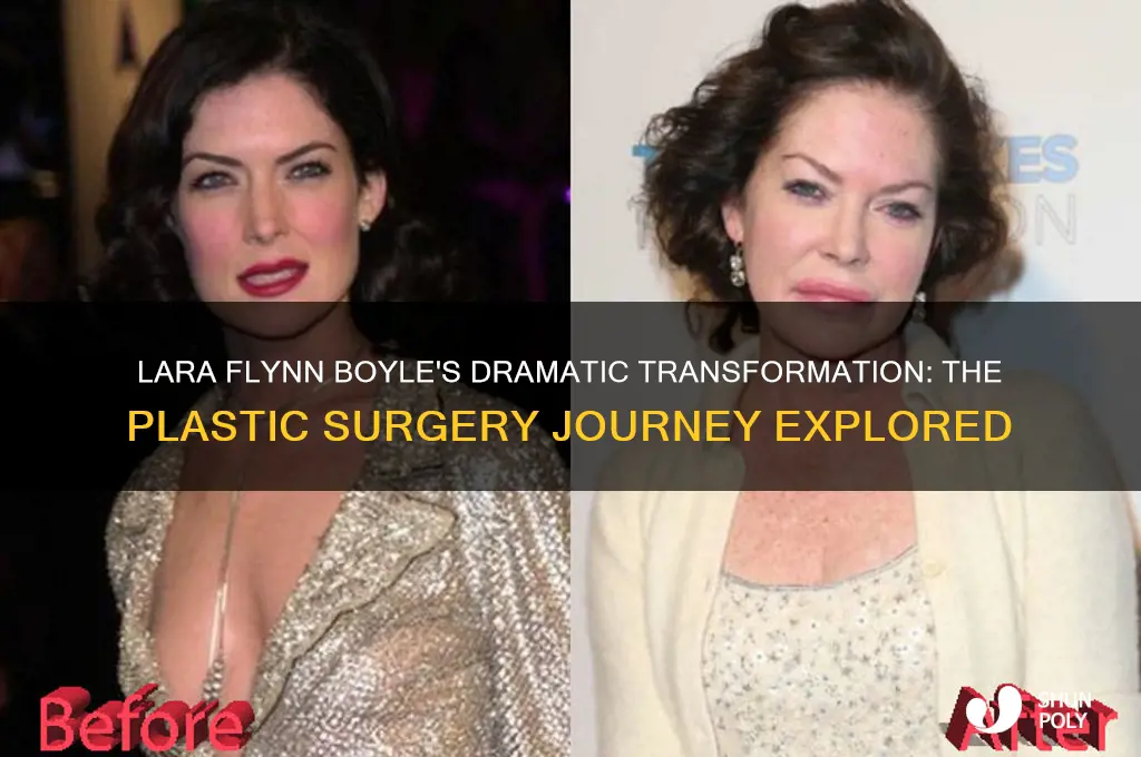 why did lara flynn boyle get so much plastic surgery