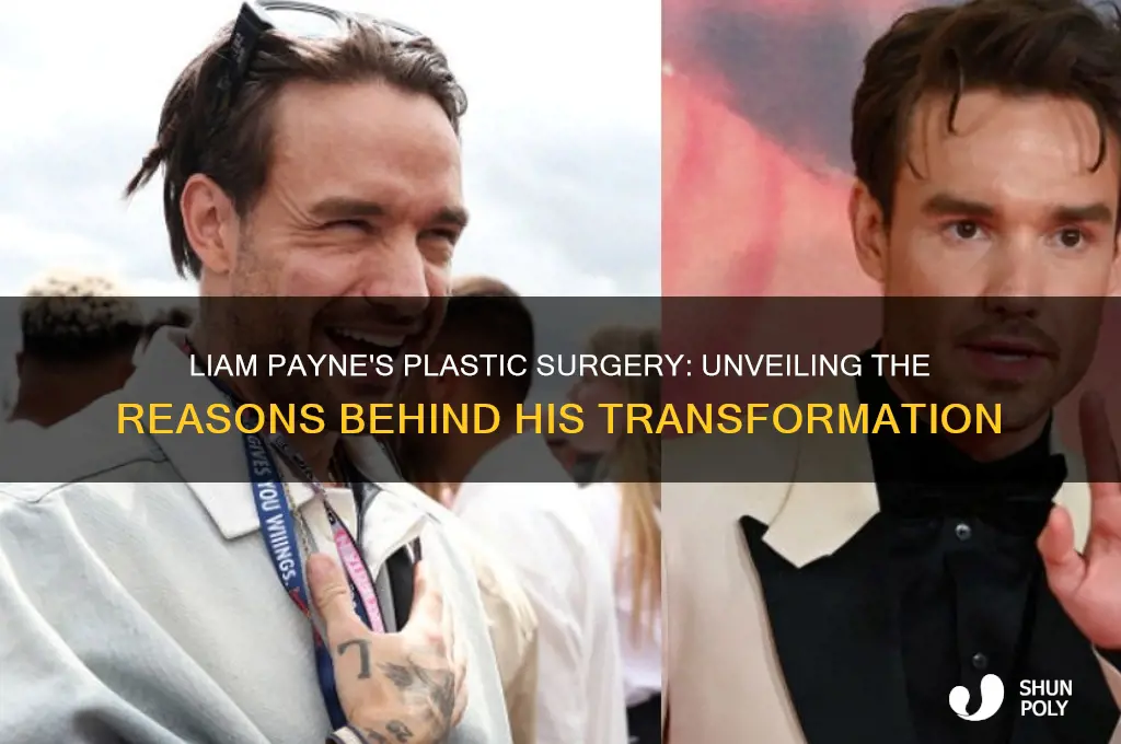 why did liam payne get plastic surgery