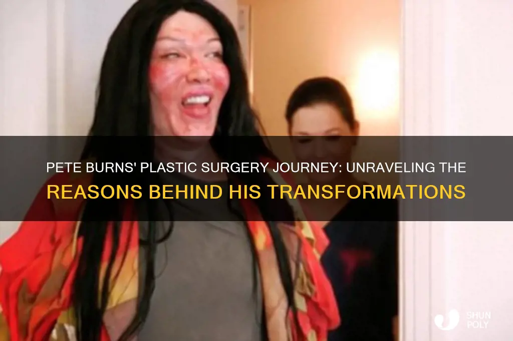 why did pete burns get plastic surgery