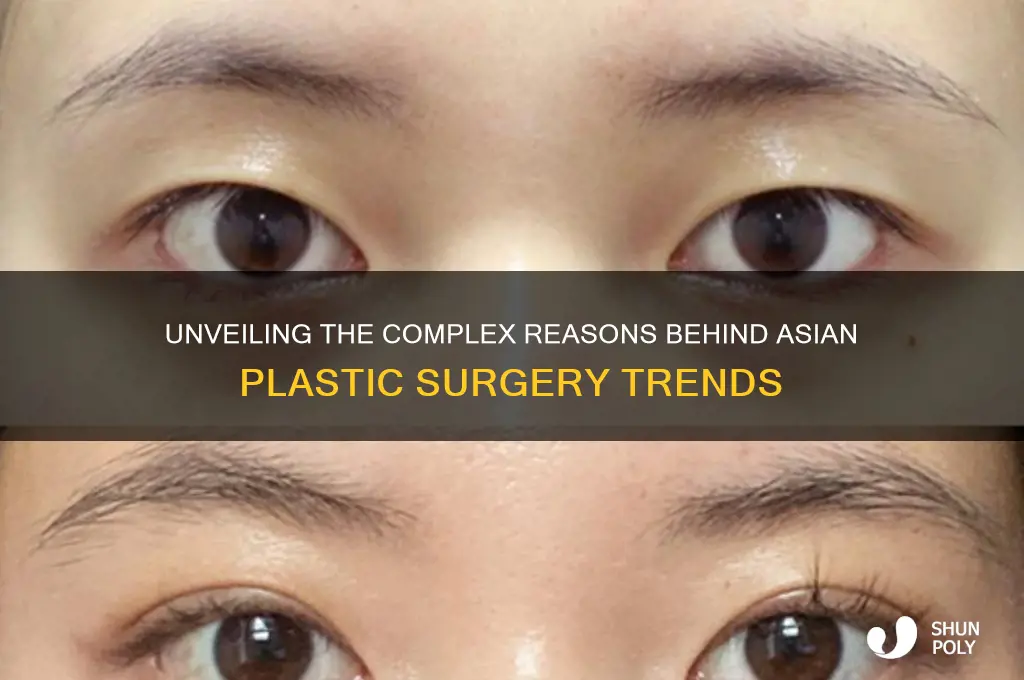 why do asians have plastic surgery to look white
