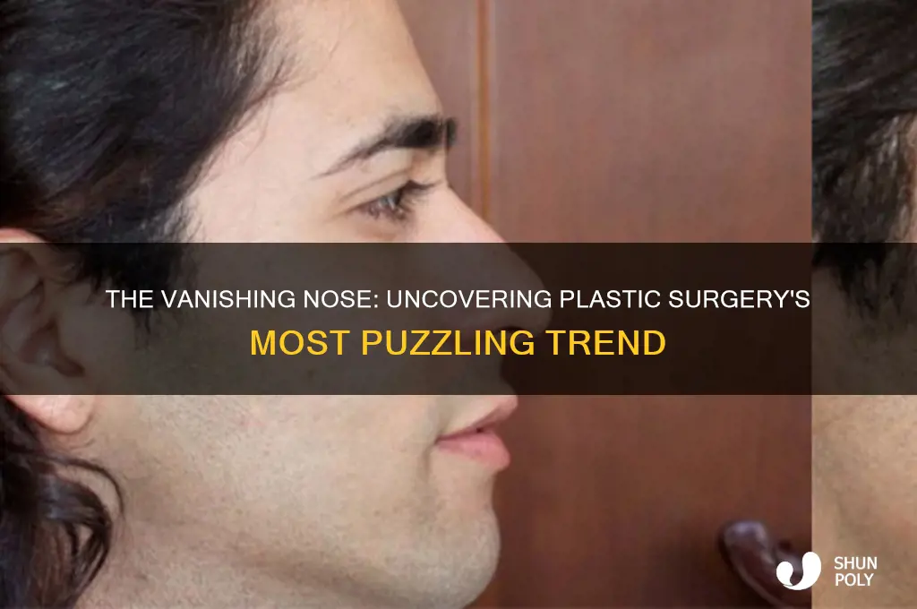 why do noses disappear when people get plastic surgery