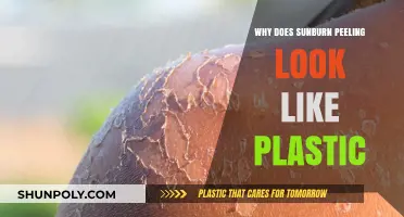 Sunburn Peeling: Plastic-Like Skin and What to Do