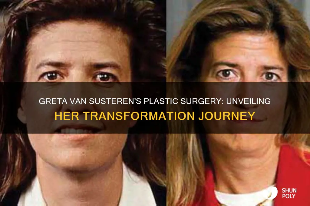 why greta van susteren had plastic surgery