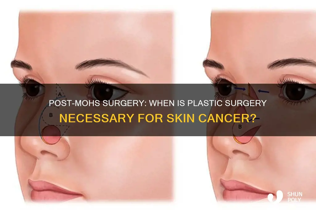 will i need plastic surgery after mohs