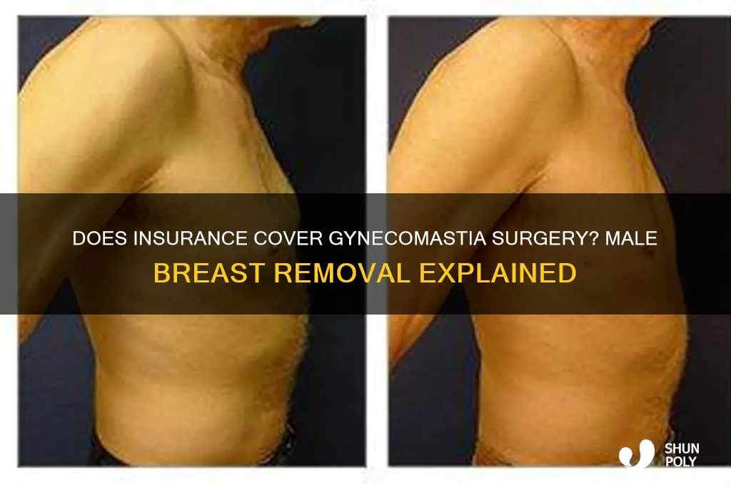 will insurance cover plastic surgery for male breast removal