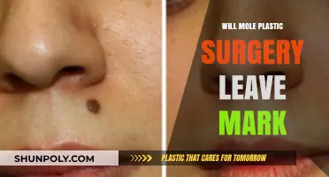 Mole Removal Surgery: Will It Leave a Visible Scar or Mark?