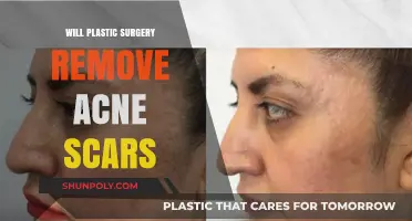 Can Plastic Surgery Effectively Eliminate Acne Scars? Expert Insights