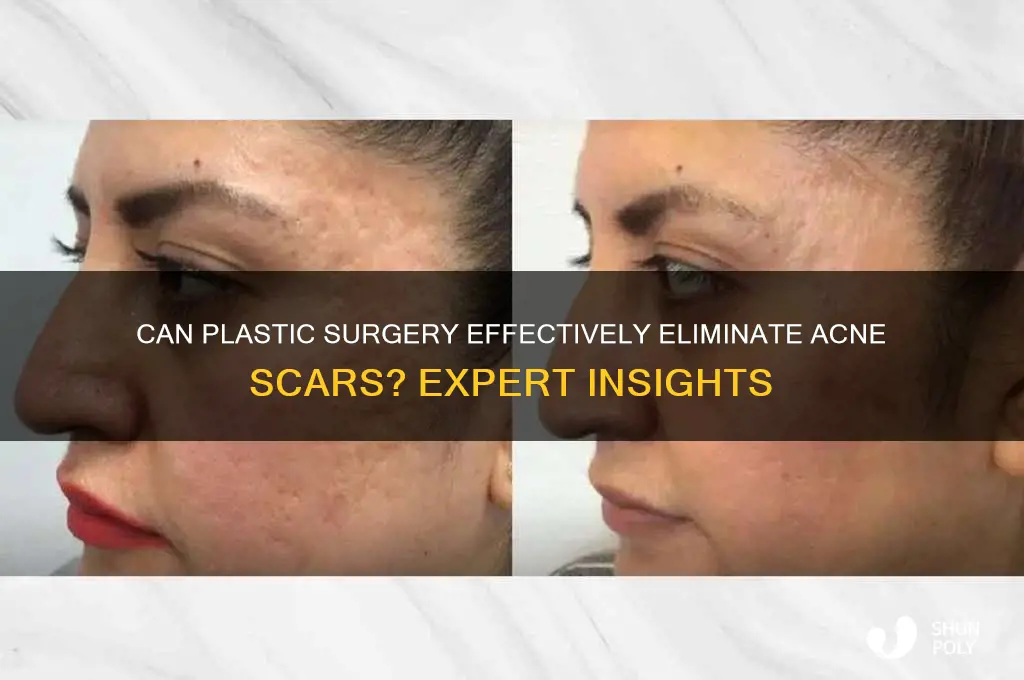 will plastic surgery remove acne scars